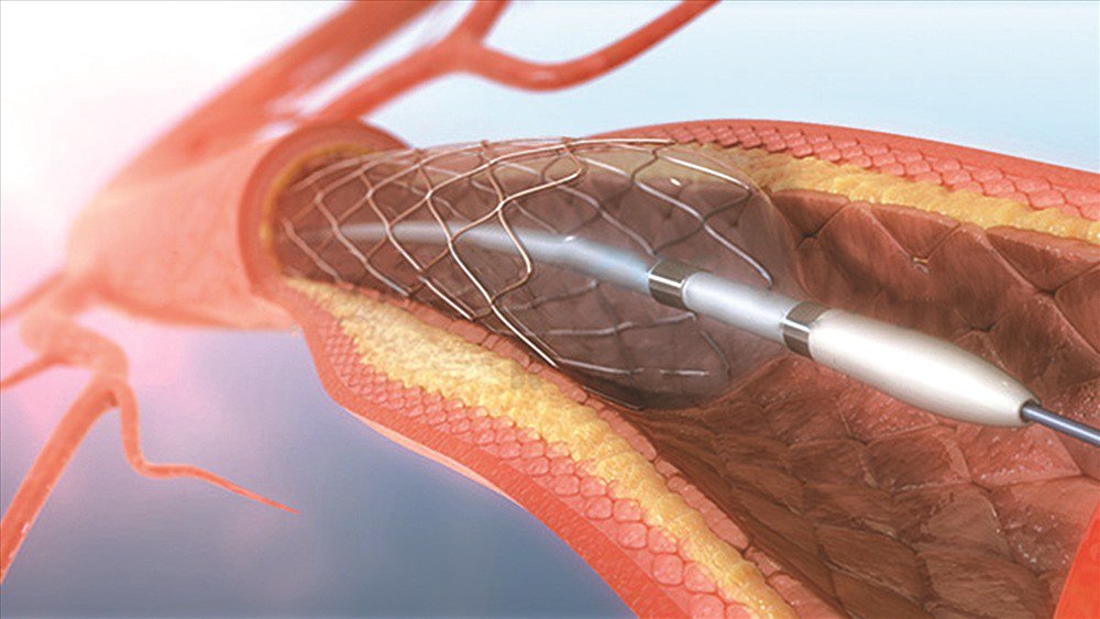 Stent hấp thụ sinh học